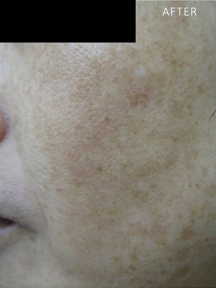 After Pigmentation