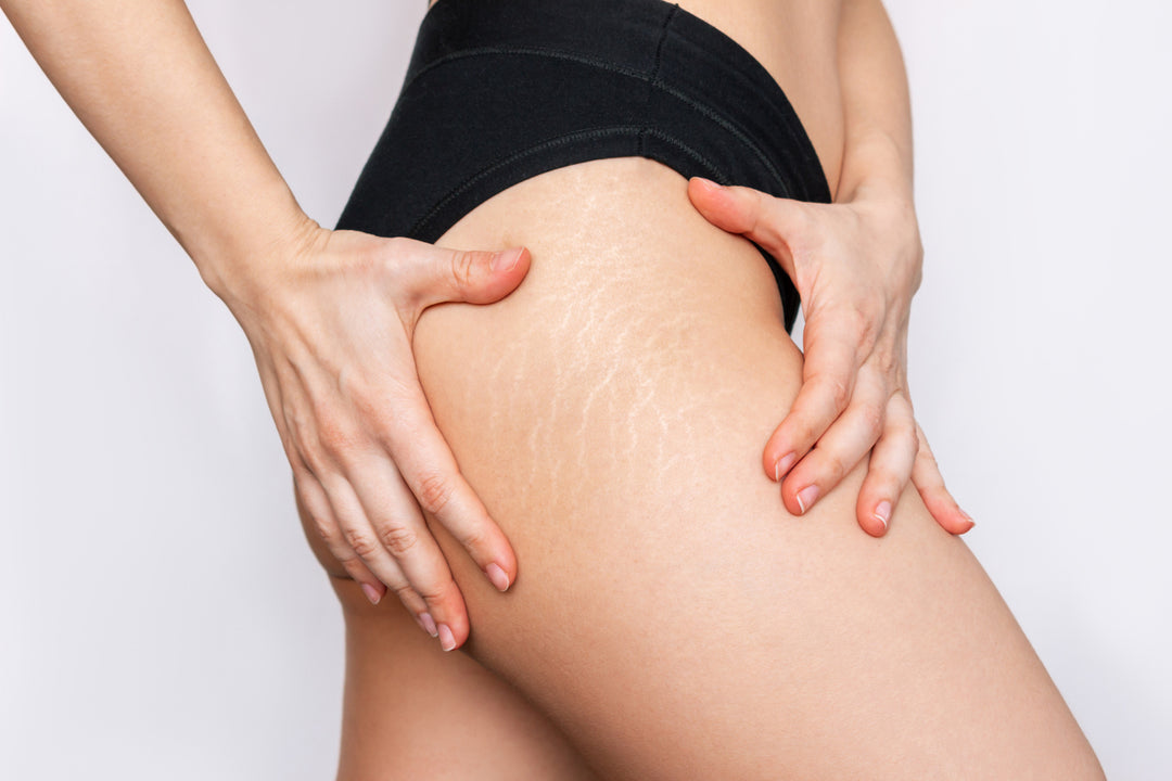 The Best Cellulite Creams by Effusion